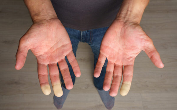 Man,Showing,Hands,With,Raynaud,Syndrome,,Raynaud’s,Phenomenon,Or,Raynaud’s